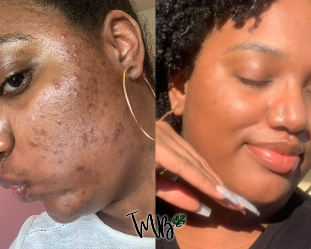 Why Do I Keep Getting Dark Spots?