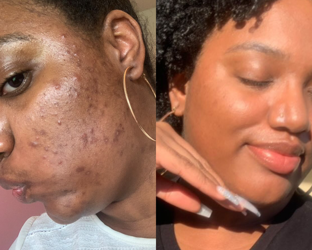 Why Does My Skincare Burn? Top Causes & How to Fix It Fast!